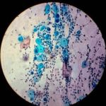 Chlamydia responsable de la lymphogranulomatose venerienne