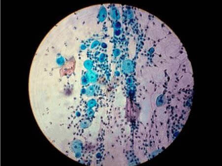 Chlamydia responsable de la lymphogranulomatose venerienne