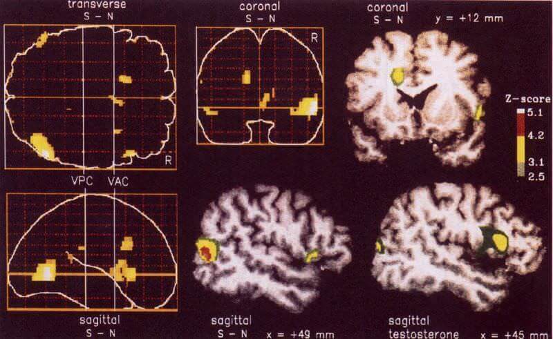 Les-regions-cerebrales-activees-par-l'excitation-sexuelle-chez-l'homme