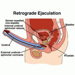 ejaculation-retrograde