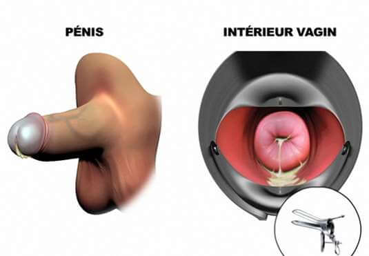 urétrite et gonorrhée