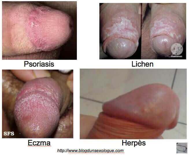 Anomalies du gland : psoriasis, Lichen, Eczéma et herpès