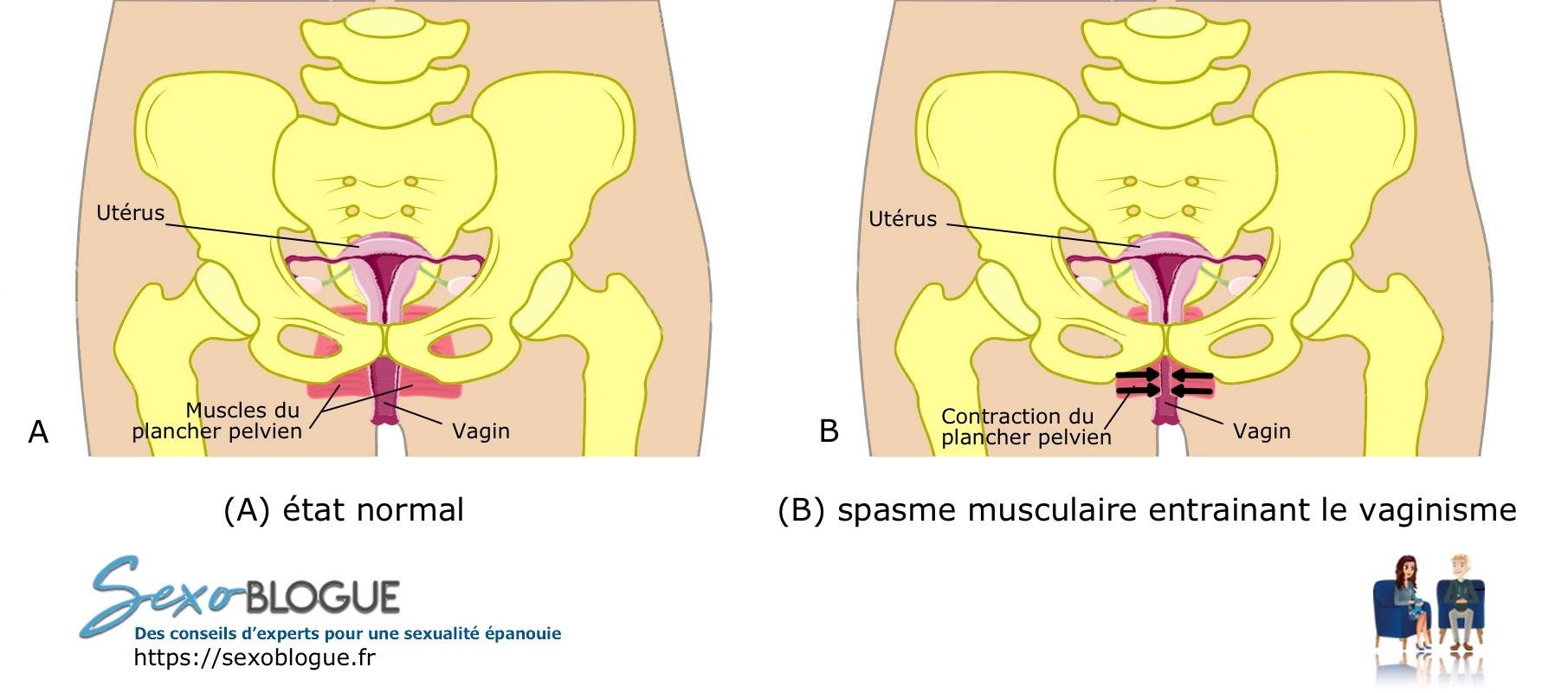 Mécanisme du vaginisme (vue frontale)