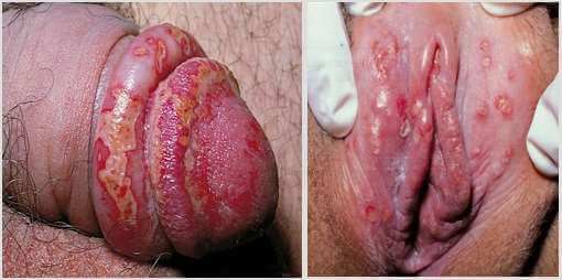 Primo-infection herpétique à gauche chez l'homme, à droite chez la femme
