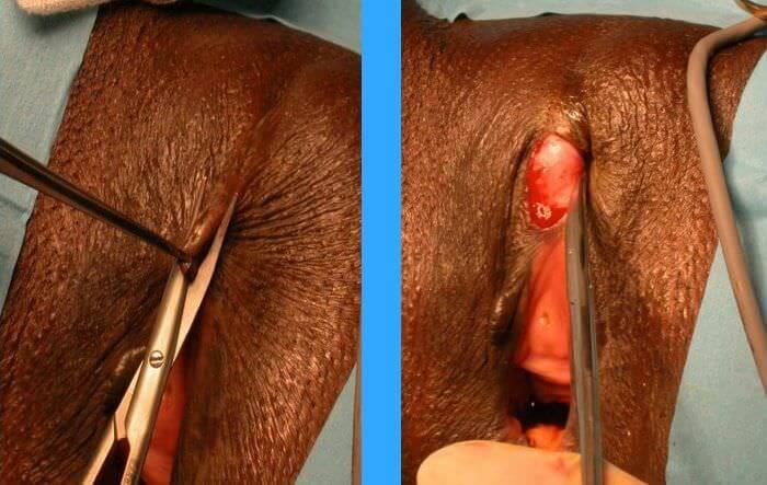 Technique chirurgicale réparation d'excision : Résection de la cicatrice