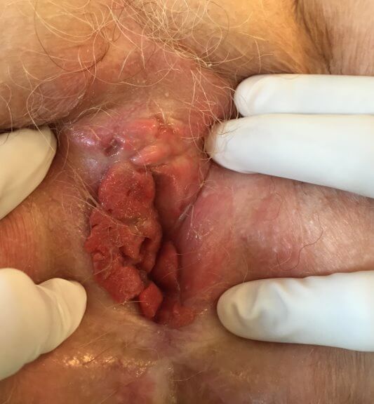 Tumeur de Buschke-Lowenstein HPV 6