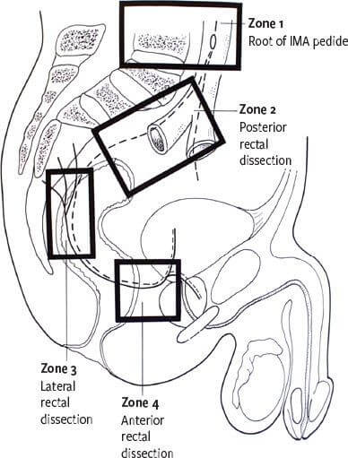 Zones à risque de lésions nerveuses lors de la chirurgie rectale